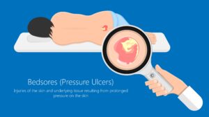 Bedsores (pressure ulcers) are injuries to the skin and underlying tissue caused by prolonged pressure from lying down or sitting for extended periods. These injuries are common in patients with paralysis and immobile adults.